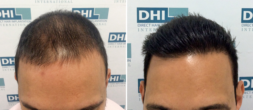 DHI before & after hair transplant results